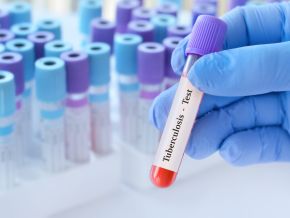 Africa CDC Tests Mobile Messaging to Tackle TB in Africa, thanks to a $100,000 World Bank grant