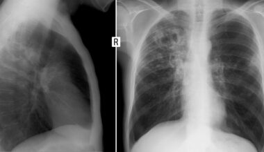 Is AI ready to interpret chest x-rays without human supervision?