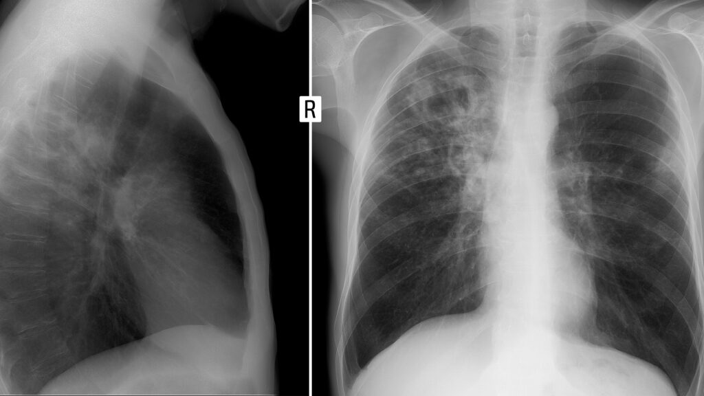 Is AI ready to interpret chest x-rays without human supervision?