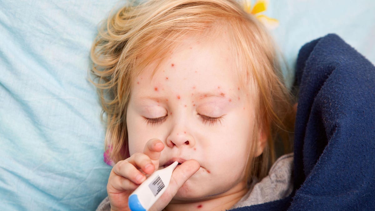 Oakland Co. warns of measles exposure at Commerce Twp. emergency room