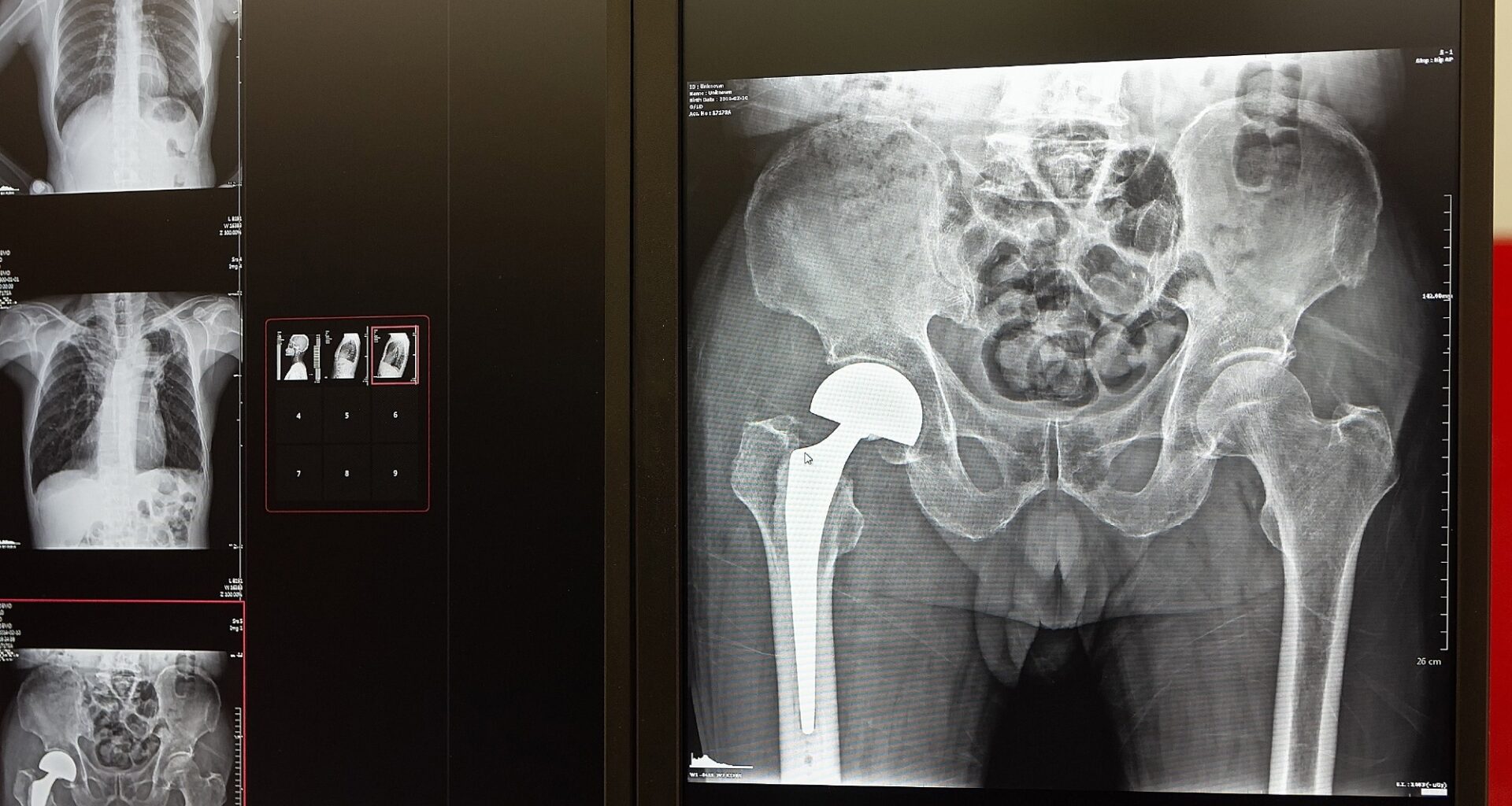 Walking speed before surgery predicts who thrives after hip replacement