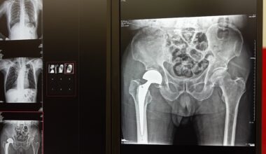 Walking speed before surgery predicts who thrives after hip replacement