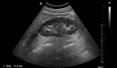 Otsuka’s kidney therapy gets accelerated FDA approval