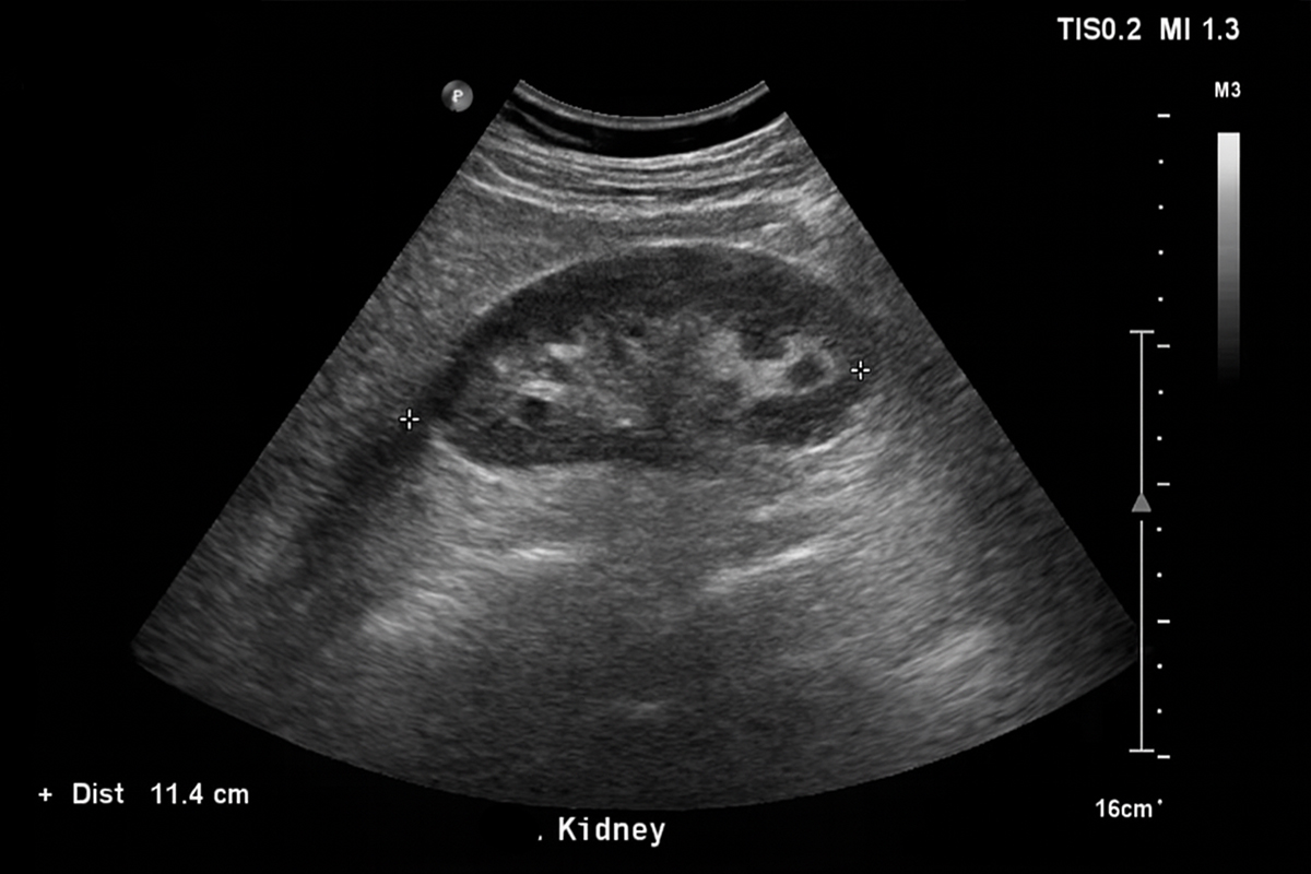 Otsuka’s kidney therapy gets accelerated FDA approval