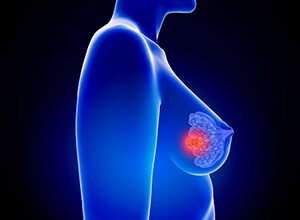 Distant Disease-Free Survival as a Surrogate for Overall Survival in Trials of Neoadjuvant Therapy in Early Breast Cancer