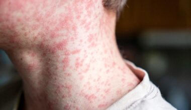 N.J. health officials warn of potential measles exposures at Newark Liberty Airport. Here's what we know.