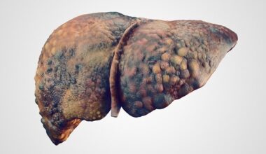 Blocking platelet-activating factor reduces liver damage in cirrhosis