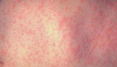 Mass. health officials warn of possible measles exposures – Boston 25 News