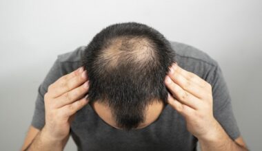 Hair-loss drug boosts hair growth by 539% – Irish study
