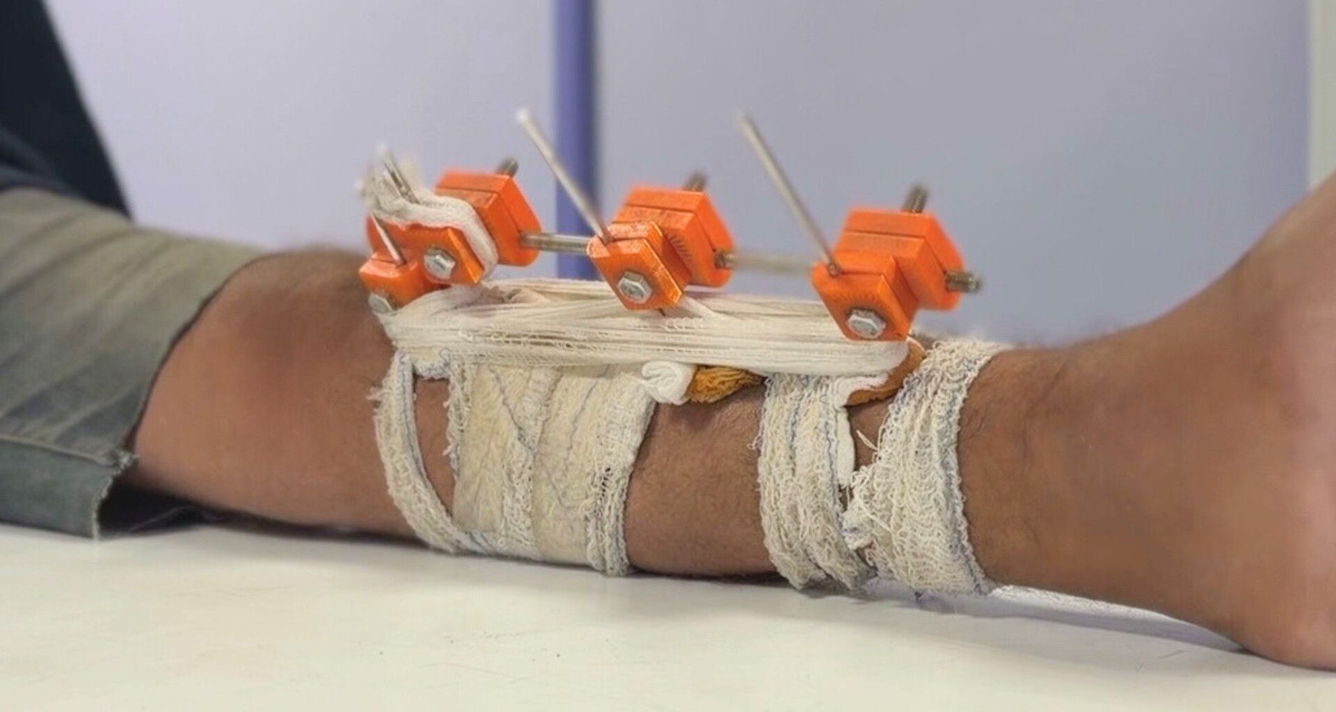 Gaza doctors use 3D tech to save limbs shattered by Israel from amputation | Israel-Palestine conflict News
