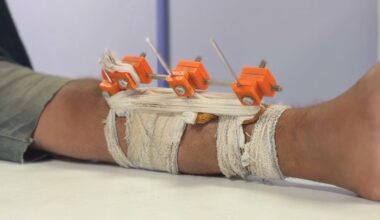 Gaza doctors use 3D tech to save limbs shattered by Israel from amputation | Israel-Palestine conflict News