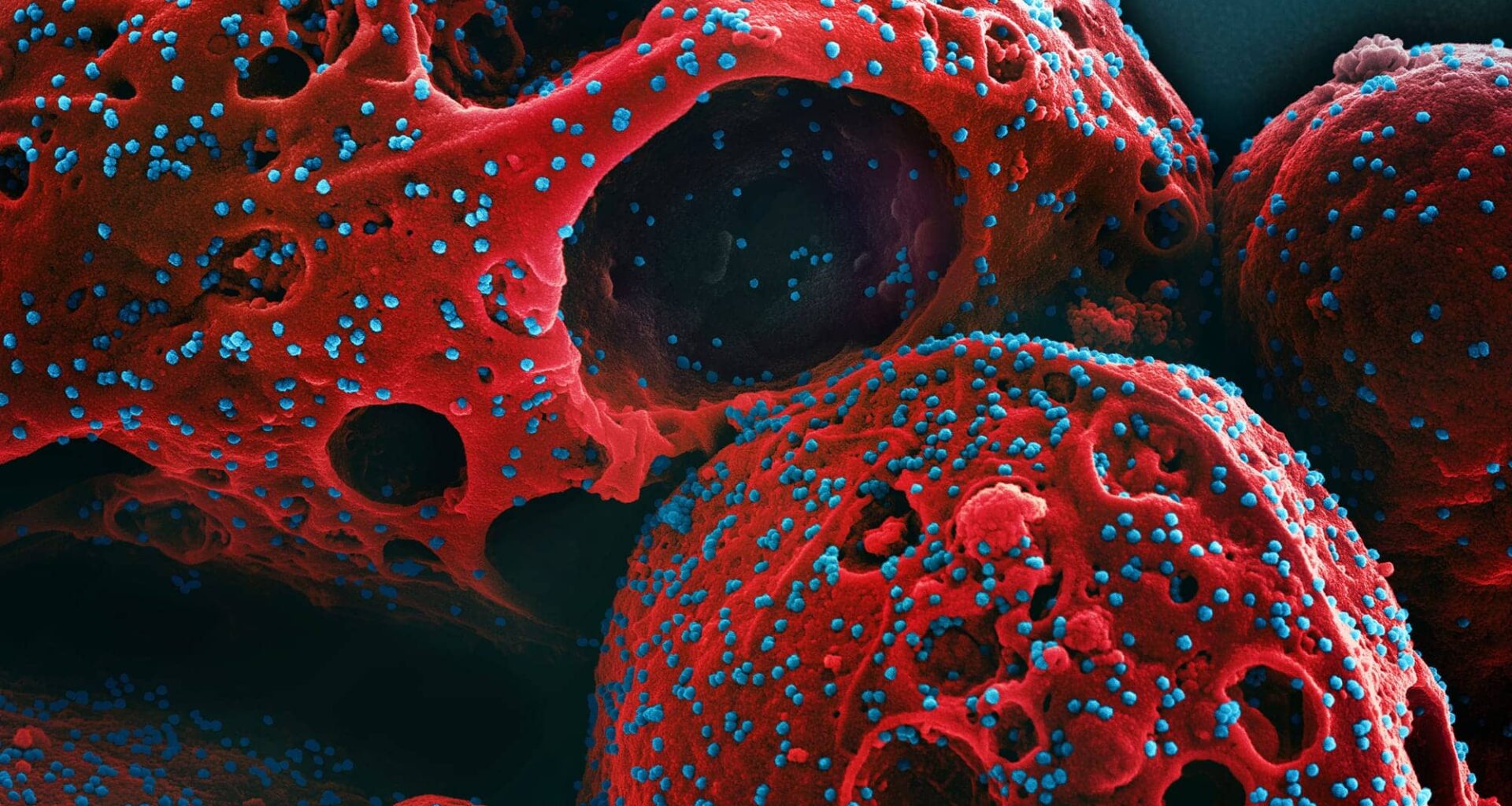 Co-Infections May Fuel Long COVID