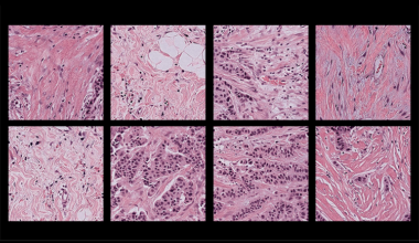 Researchers Discover Bias in AI Models That Analyze Pathology Samples