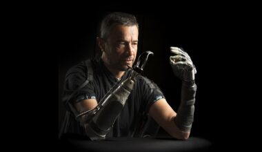 Amputees often feel disconnected from their bionic hands. AI could bridge the gap : Shots
