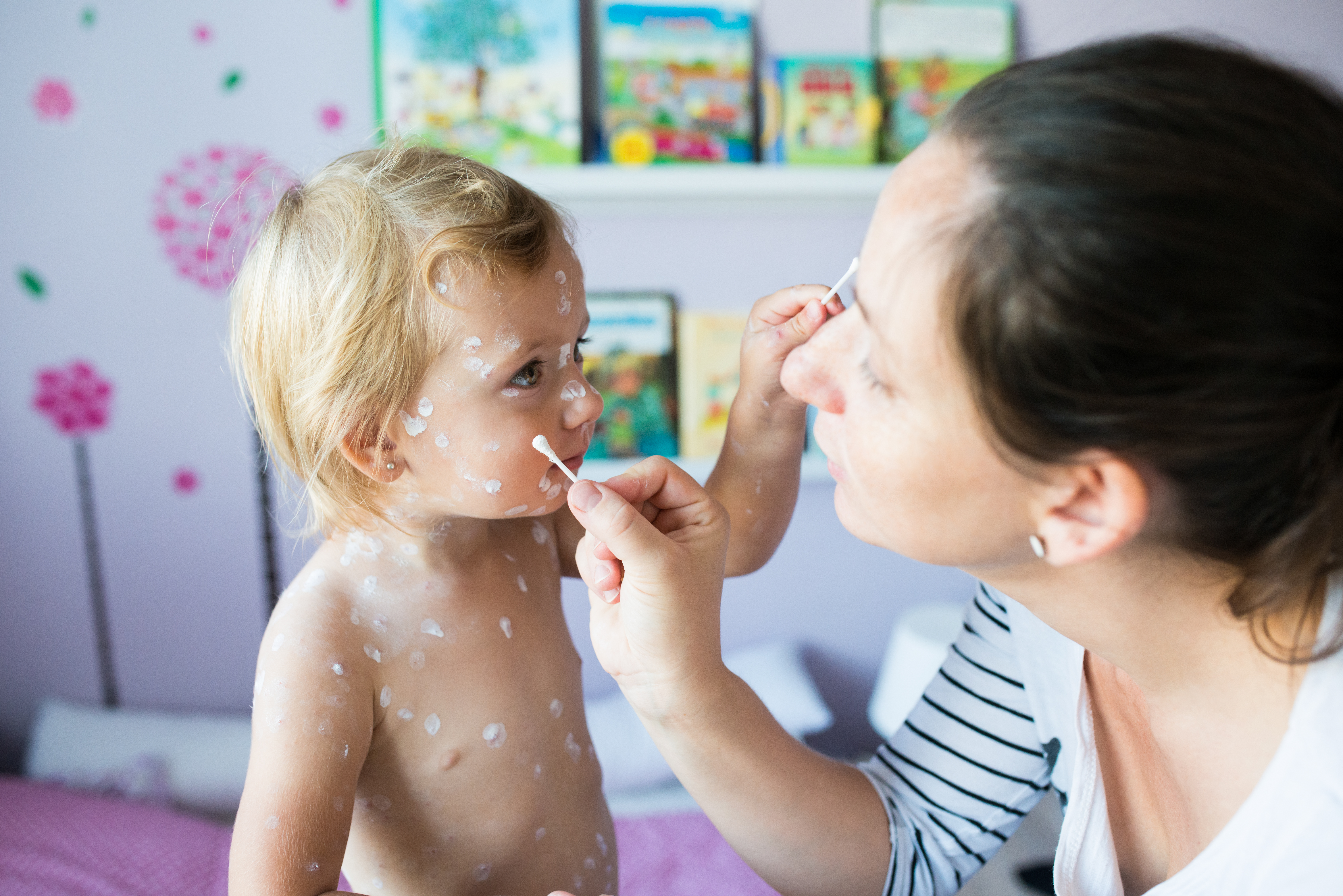 Mother applies antiseptic cream to her two-year-old daughter with chickenpox.