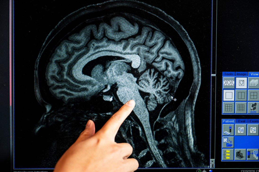 A finger points to an image of a brain taken inside an MRI machine.