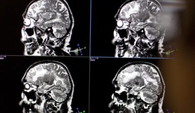 Geneva scientists find new approach for schizophrenia symptoms