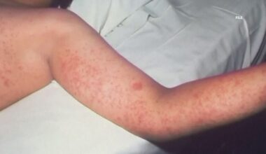 NC health officials confirm new case of measles amid South Carolina outbreak