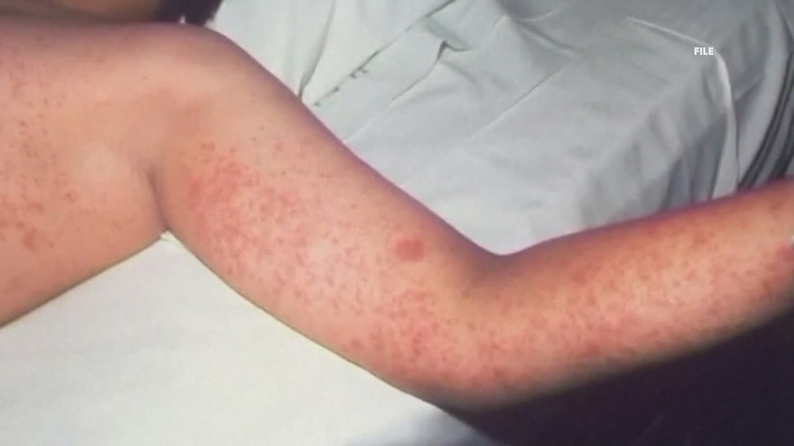 NC health officials confirm new case of measles amid South Carolina outbreak