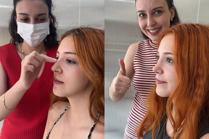 A surgeon shows a before and after example of the "Barbie nose" on TikTok.