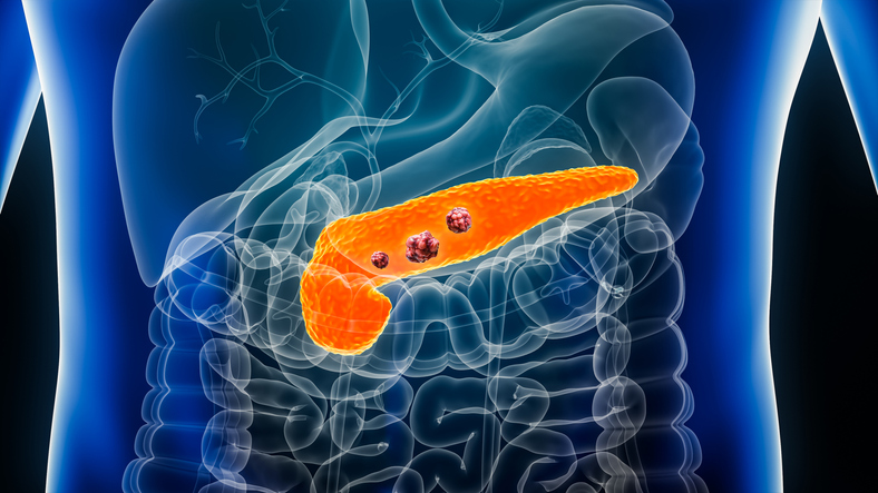 pancreatic cancer