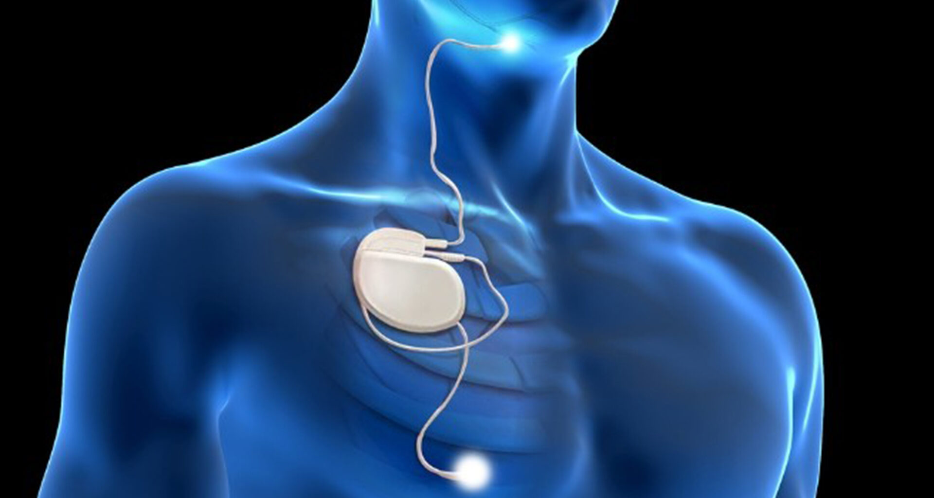 Implant treatment for sleep apnoea