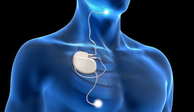 Implant treatment for sleep apnoea