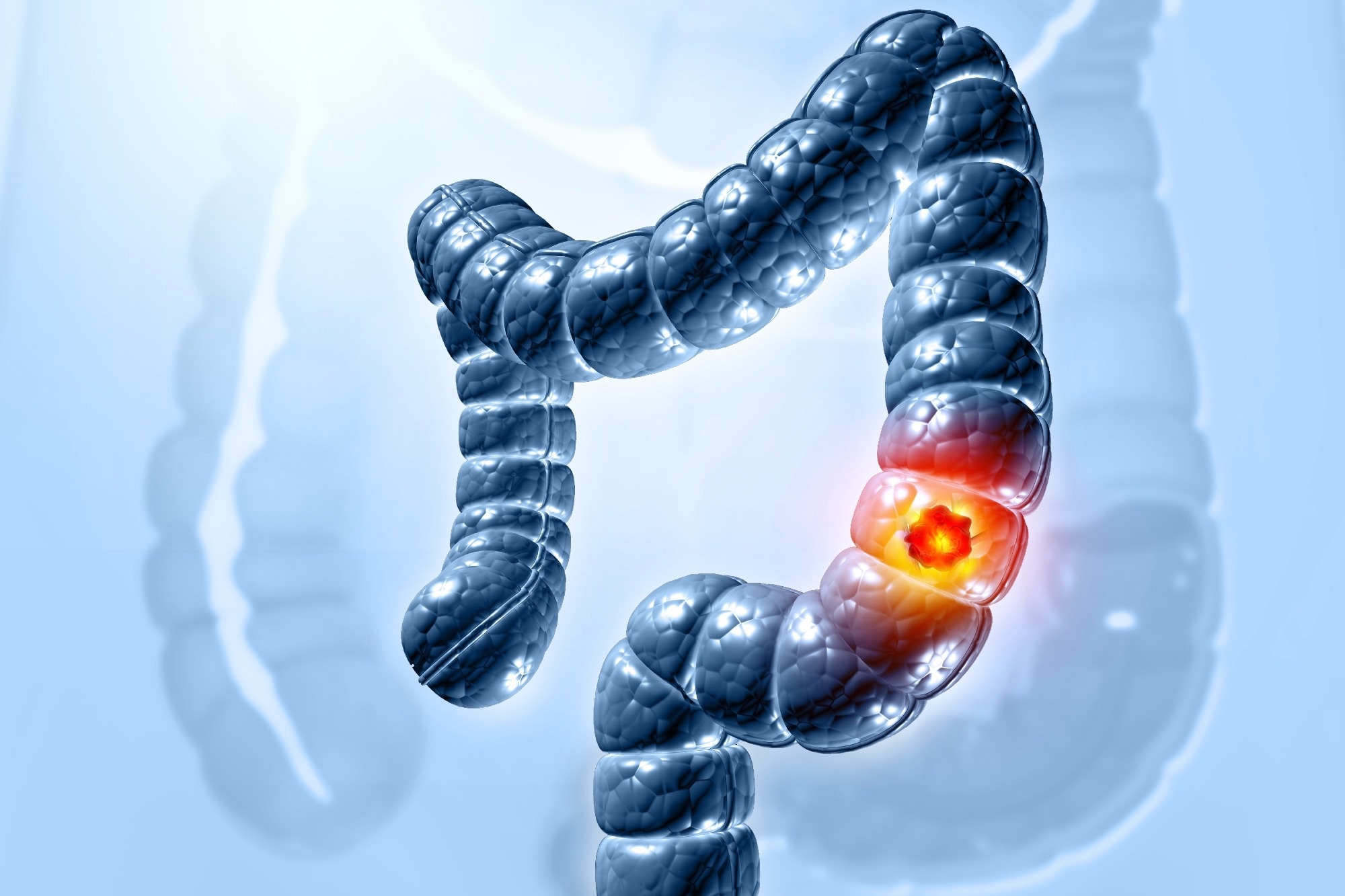 Study: Association of alcohol intake over the lifetime with colorectal adenoma and colorectal cancer risk in the Prostate, Lung, Colorectal, and Ovarian Cancer Screening Trial. Image Credit: crystal light / Shutterstock