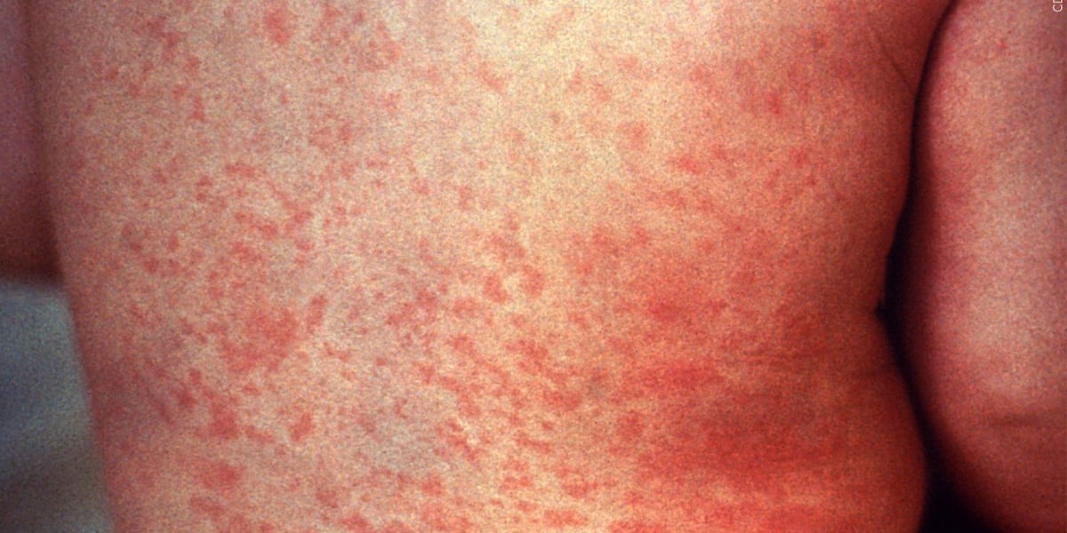VDH confirms another measles case
