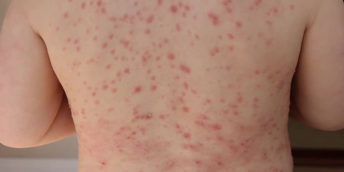Health officials tracking measles outbreak in Ohio