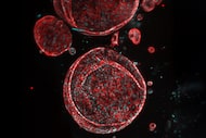 This image shows liver organoids generated from a patient liver biopsy with alcoholic liver...