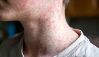 New measles case confirmed in western North Carolina