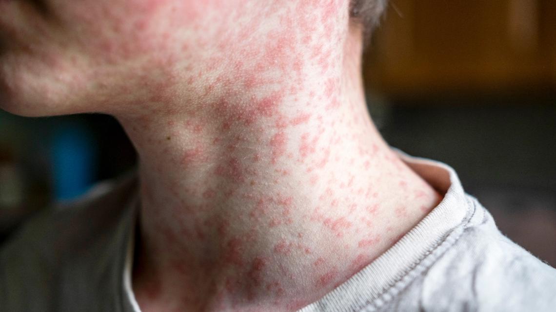 New measles case confirmed in western North Carolina