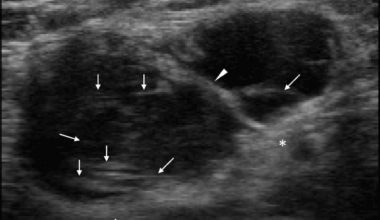 Myxofibrosarcomas Have Extremely Low Internal Echoes: A Case Report