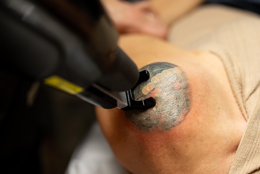 A laser tattoo removal gun shoots a circular tattoo on a woman's shoulder. 