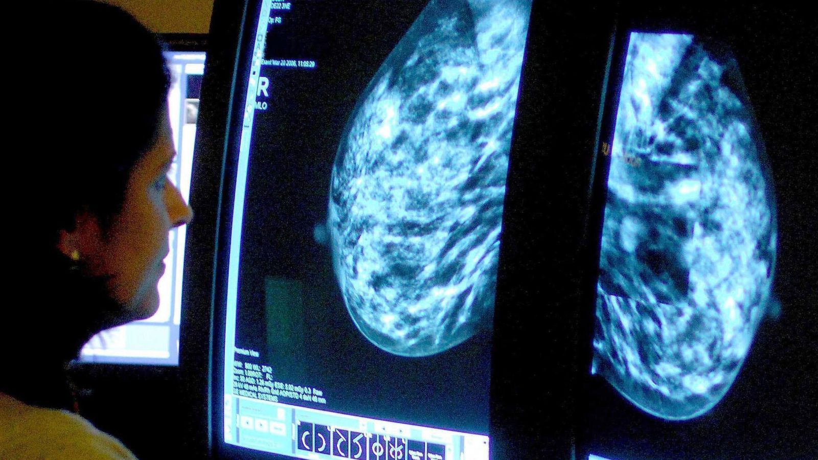 Mammograms currently need two radiologists to assess the results. Pic: PA