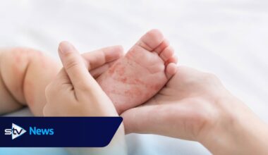 First confirmed measles case in NHS Grampian in more than decade