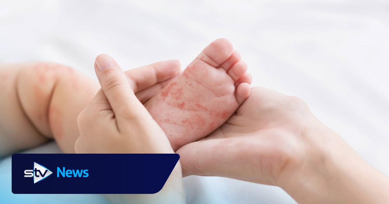 First confirmed measles case in NHS Grampian in more than decade