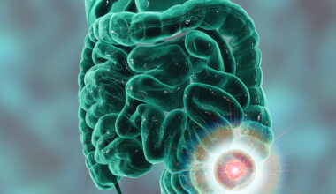 FDA Approves Encorafenib for Metastatic BRAF V600E–Mutated Colorectal Cancer