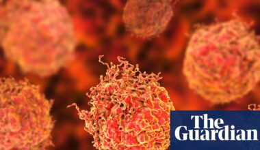 Researchers praise ‘stunning’ results of new prostate cancer treatment | Prostate cancer