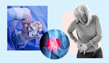 NHS joint replacements get go-ahead amid bone cement shortage