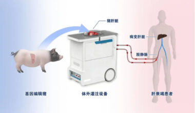 Illustration of the treatment of a liver failure patient using ex vivo perfusion with a six-gene-edited pig liver Photo: Screenshot from the WeChat account of Xijing Hospital
