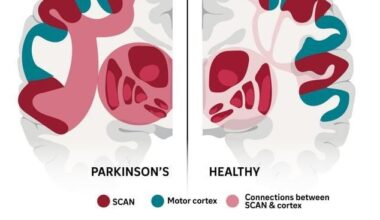 Parkinson’s Linked to Faulty Brain Network, Treatment Efficacy Doubled - 조선일보