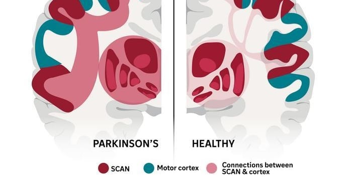 Parkinson’s Linked to Faulty Brain Network, Treatment Efficacy Doubled - 조선일보