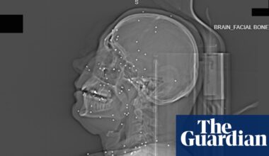 ‘Deliberate targeting of vital body parts’: X-rays taken after Iran protests expose extent of catastrophic injuries | Iran