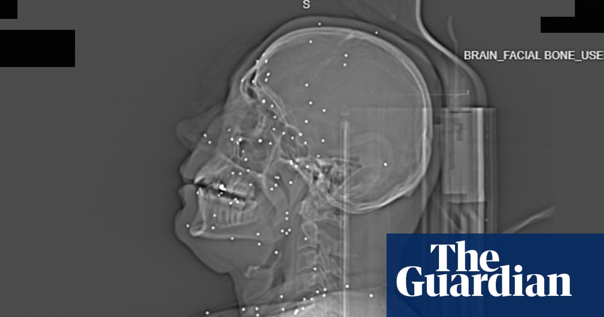 ‘Deliberate targeting of vital body parts’: X-rays taken after Iran protests expose extent of catastrophic injuries | Iran
