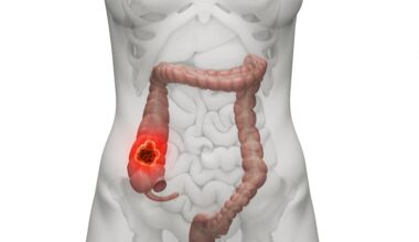 MRI Radiomics Improves Rectal Cancer Risk Stratification