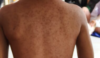 Health officials warn of possible measles exposure at Pa. urgent care center