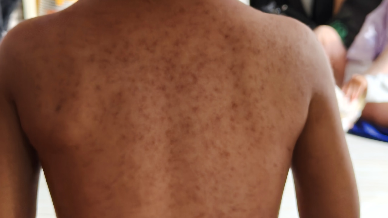 Health officials warn of possible measles exposure at Pa. urgent care center