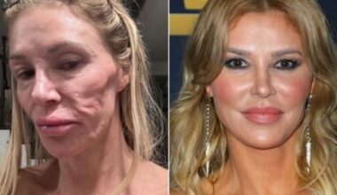 Brandi Glanville's Facial Deformity Linked to Ruptured Implant - 조선일보